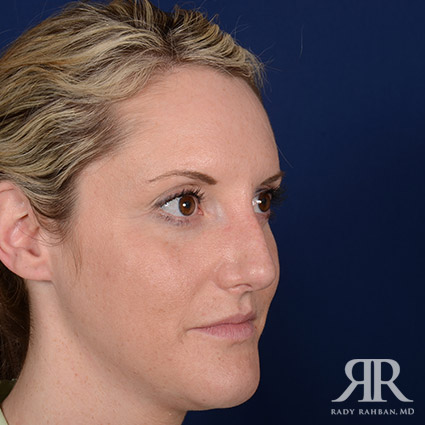 Female Rhinoplasty