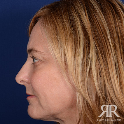 Female Rhinoplasty