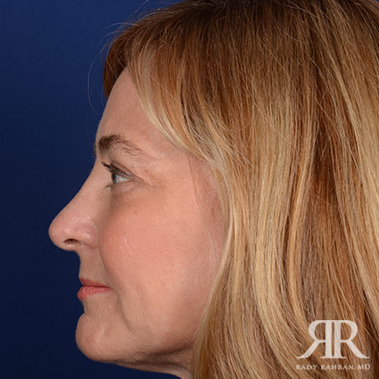 Female Rhinoplasty