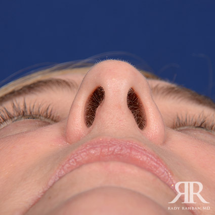 Female Rhinoplasty