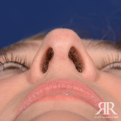 Female Rhinoplasty