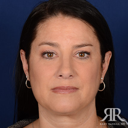 Female Rhinoplasty