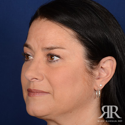 Female Rhinoplasty