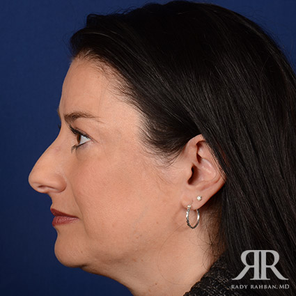 Female Rhinoplasty