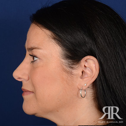 Female Rhinoplasty