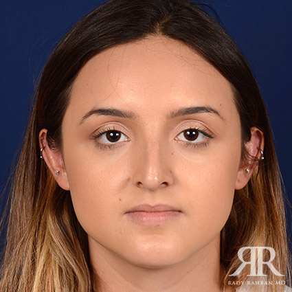 Female Rhinoplasty