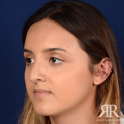 Female Rhinoplasty