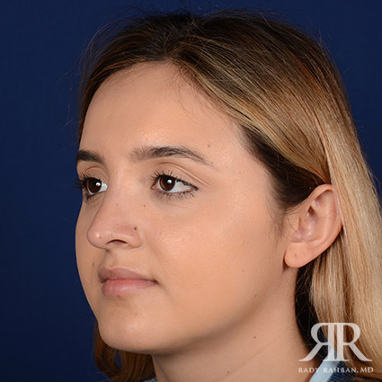 Female Rhinoplasty