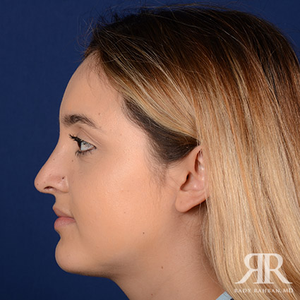 Female Rhinoplasty