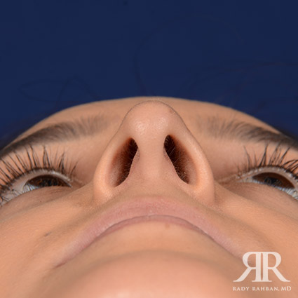 Female Rhinoplasty