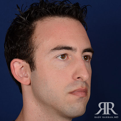 Male Rhinoplasty