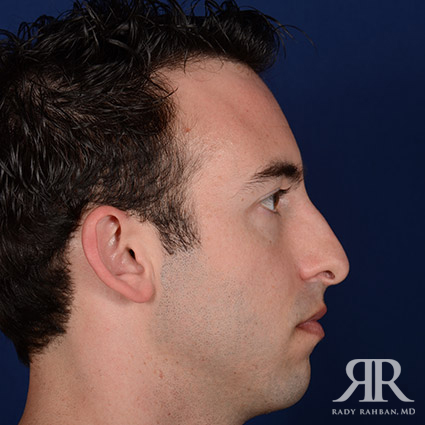 Male Rhinoplasty