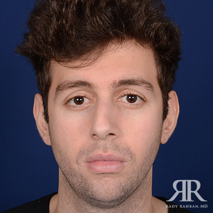 Male Rhinoplasty