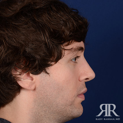 Male Rhinoplasty