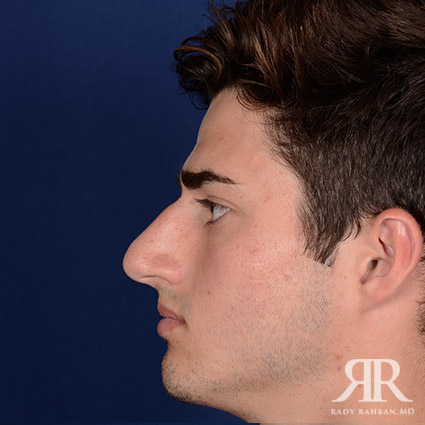 Male Rhinoplasty