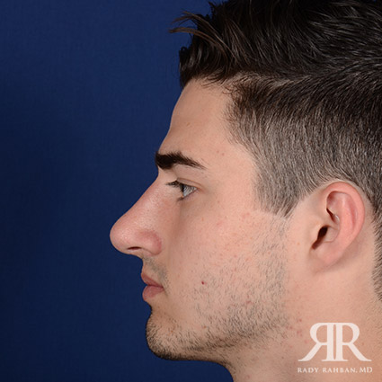 Male Rhinoplasty