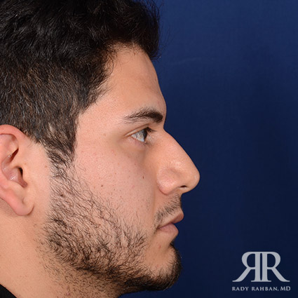Male Rhinoplasty