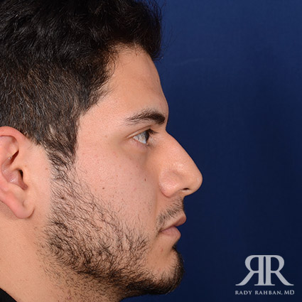 Male Rhinoplasty