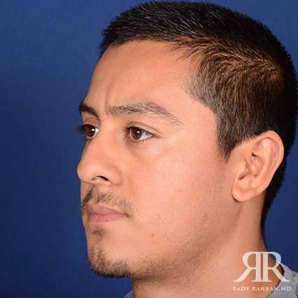 Male Rhinoplasty