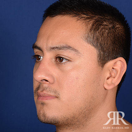 Male Rhinoplasty