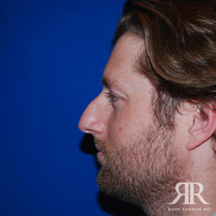 Male Rhinoplasty