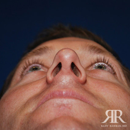 Male Rhinoplasty