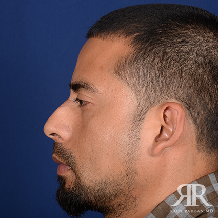 Male Rhinoplasty