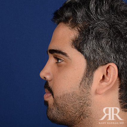 Male Rhinoplasty