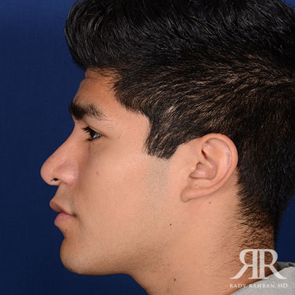 Male Rhinoplasty