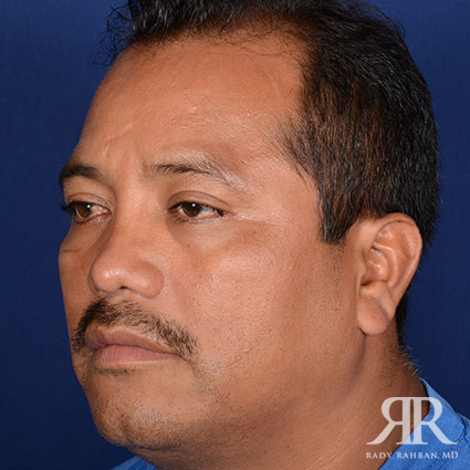 Male Rhinoplasty