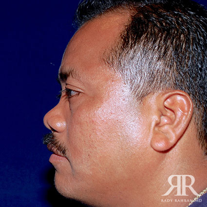 Male Rhinoplasty