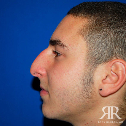 Male Rhinoplasty