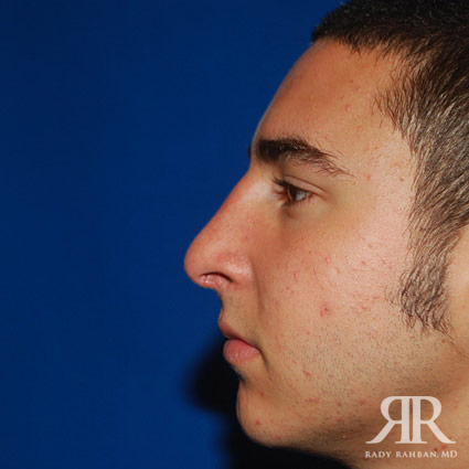 Male Rhinoplasty