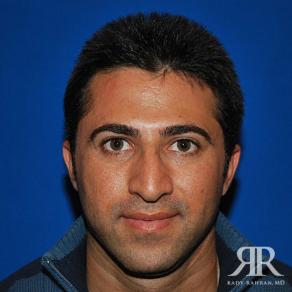 Male Rhinoplasty