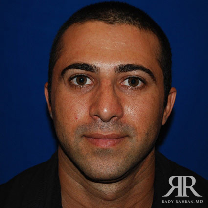 Male Rhinoplasty