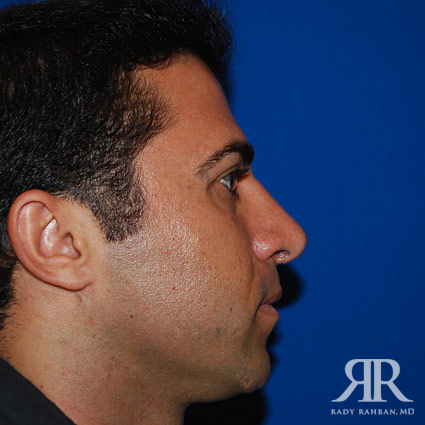 Male Rhinoplasty