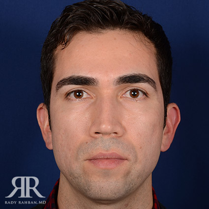 Male Rhinoplasty