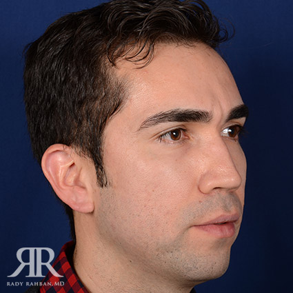 Male Rhinoplasty