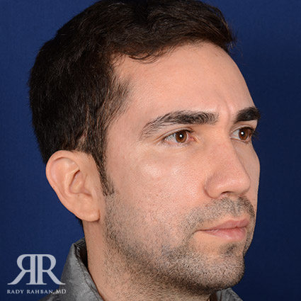 Male Rhinoplasty