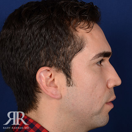 Male Rhinoplasty