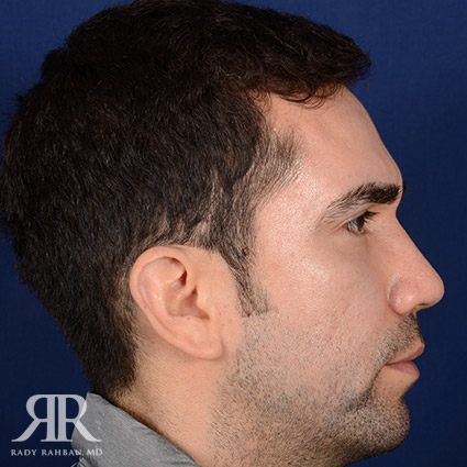 Male Rhinoplasty