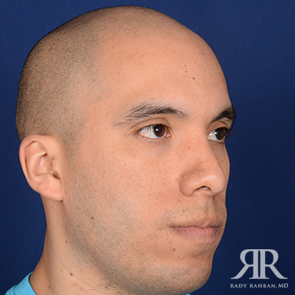 Male Rhinoplasty