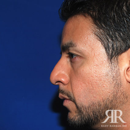 Male Rhinoplasty