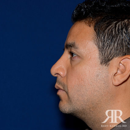 Male Rhinoplasty