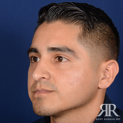 Male Rhinoplasty