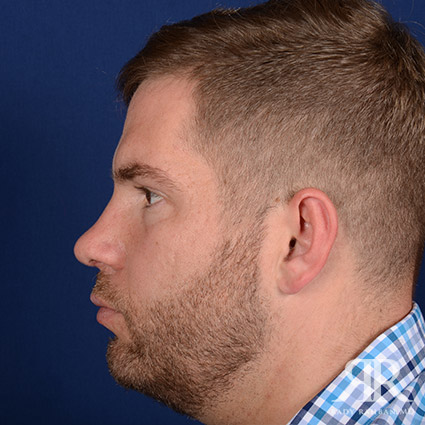 Male Rhinoplasty