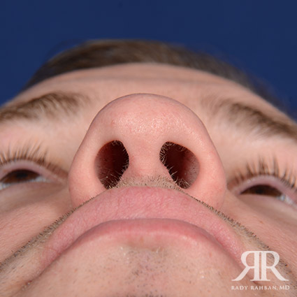 Male Rhinoplasty