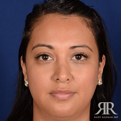 Corrective / Revision Rhinoplasty