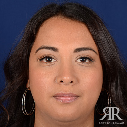 Woman that received revision rhinoplasty