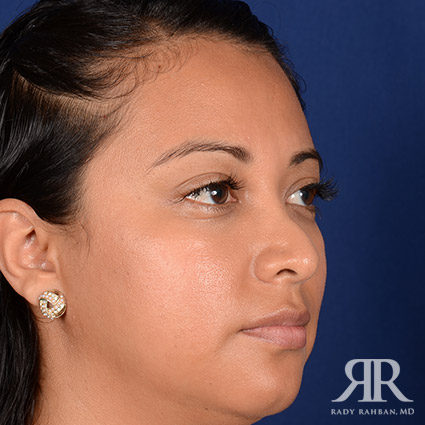 Corrective / Revision Rhinoplasty